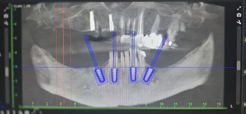 CBCT 3D snimanje zubne čeljusti za planiranje implantata