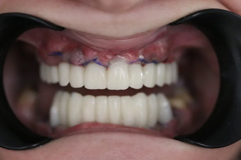 Starija pacijentica zadovoljna nakon zygoma implantata
