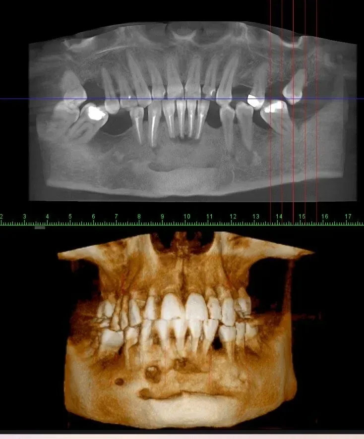 CBCT 3D dijagnostika za planiranje All-on-6