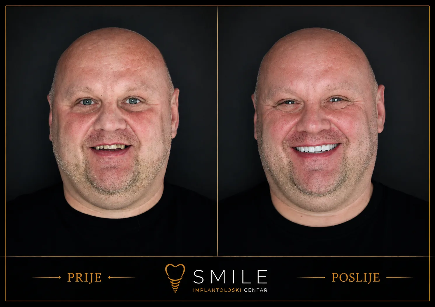 Transformacije svakodnevno nastaju u Implantološkom centru Smile u Bjelovaru