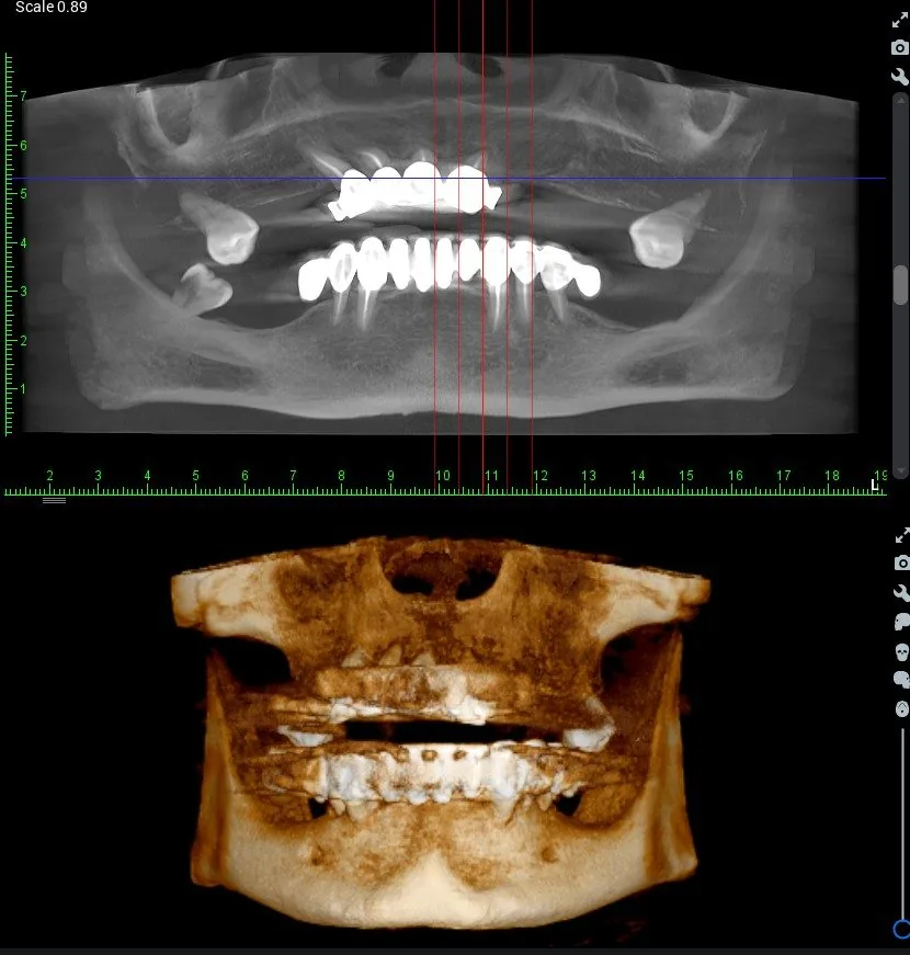 CBCT 3D dijagnostika čeljusti