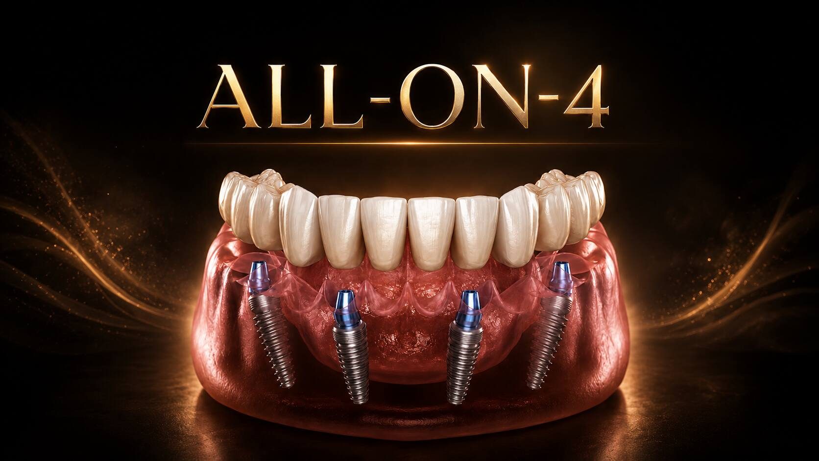 All-on-4 Implant centar Smile Bjelovar